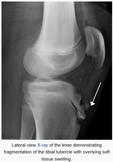 Osteopathic care for apophysitis