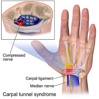 Anatomy of the carpal tunnel, showing the median nerve passing through the tight space it shares with the finger tendons
